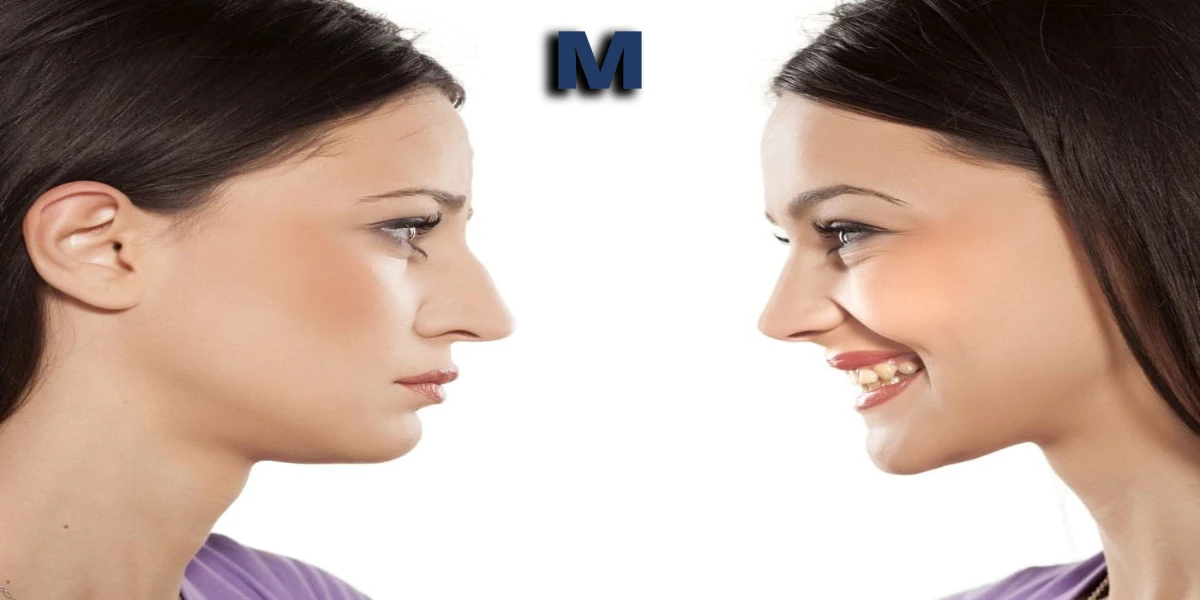 بهترین جراح بینی گوشتی در تهران