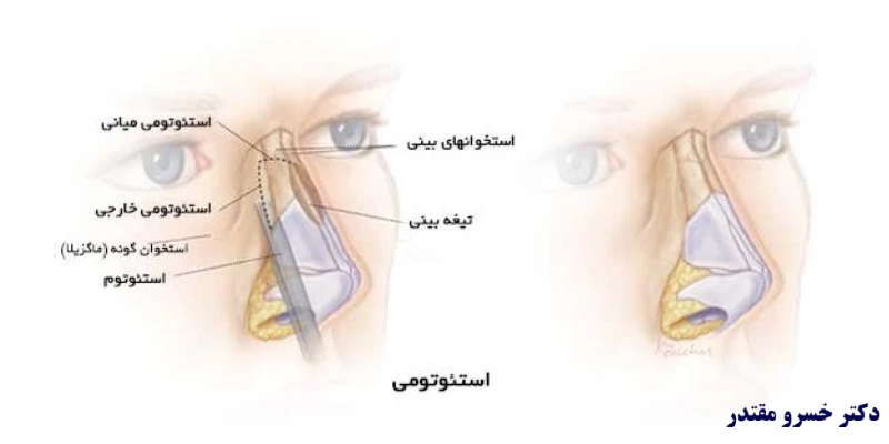 استئوتومی یک_طرفه در مقابل دوطرفه