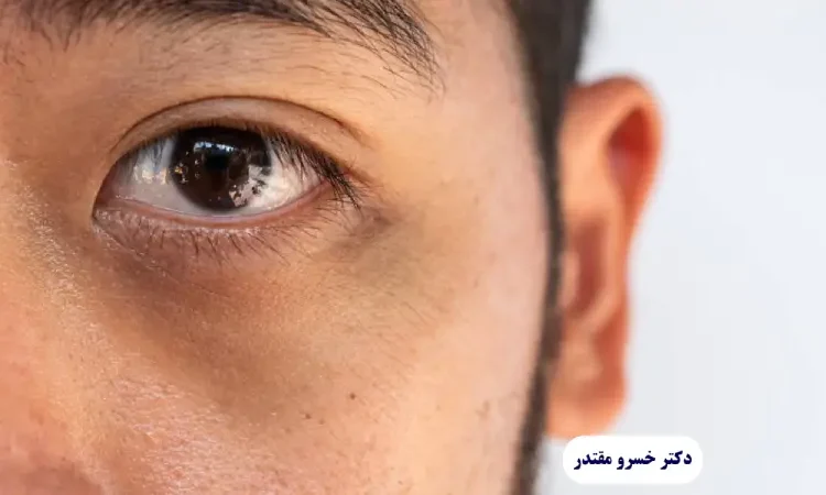  سیاهی دور چشم بعد از جراحی بینی