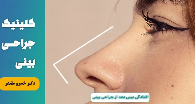  افتادگی نوک بینی بعد از جراحی بینی