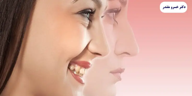 جراحی بینی بدون بیهوشی در تهران