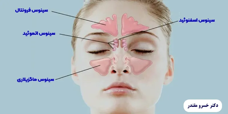 درمان سینوزیت