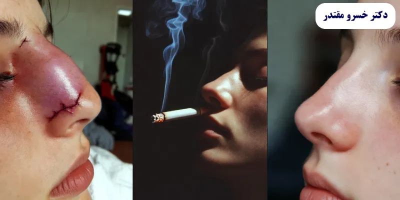 تأثیر سیگار بر بهبودی پس از جراحی بینی